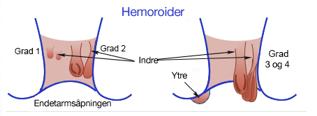 Hemoroider finnes i 4 grader Hemoroider blir delt opp i 4 grader