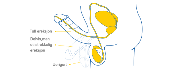 ereksjon av penis