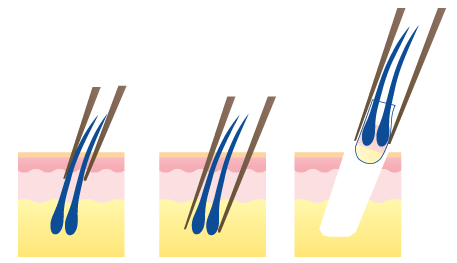 Follicular Unit Extraction