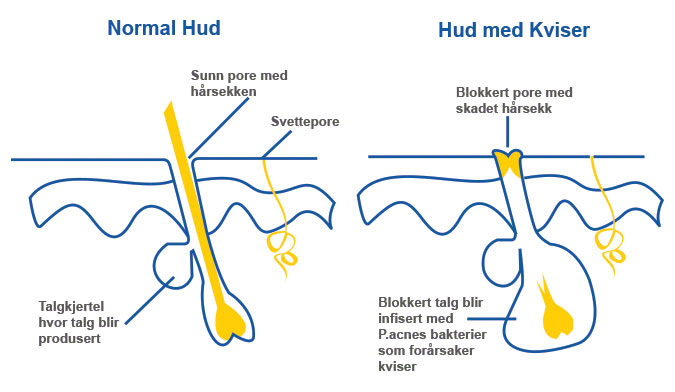 Slik oppstår akne