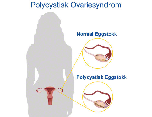 Polycystic eggstokksyndrom