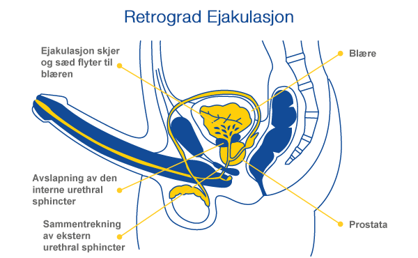 Retrograde ejakuleringsdiagram